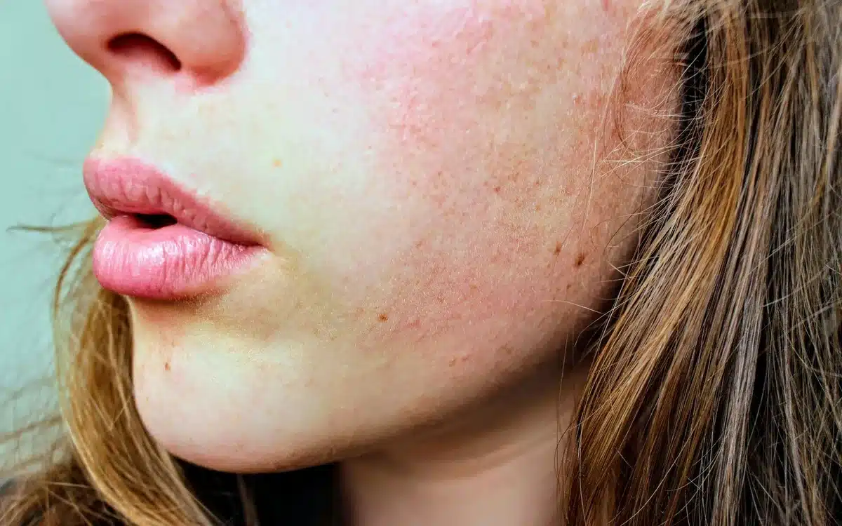 Close-up of a person's arm showing a skin rash or hives.